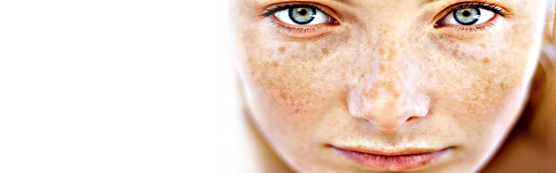 Melasma