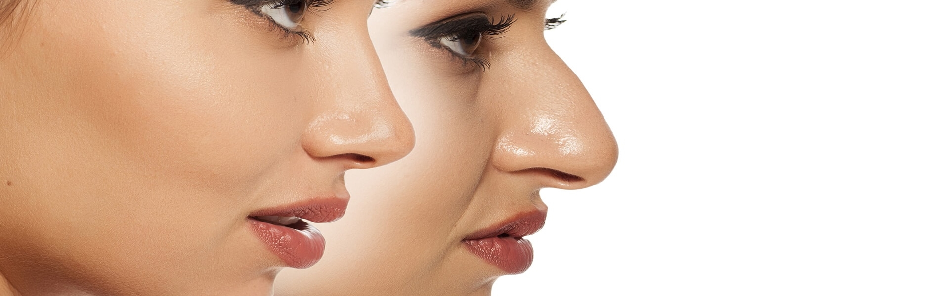 Rhinoplasty